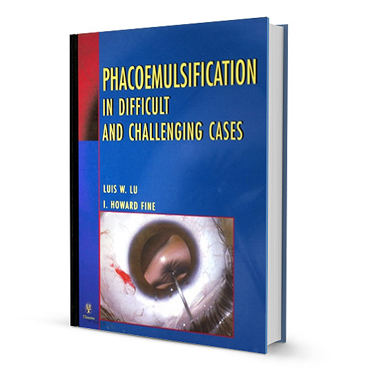 Phacoemulsification in difficult and challenging cases.