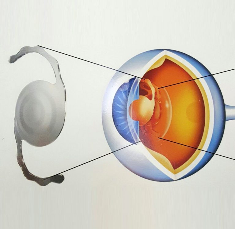 lentes-multifocais-em-cirurgia-de-catarata
